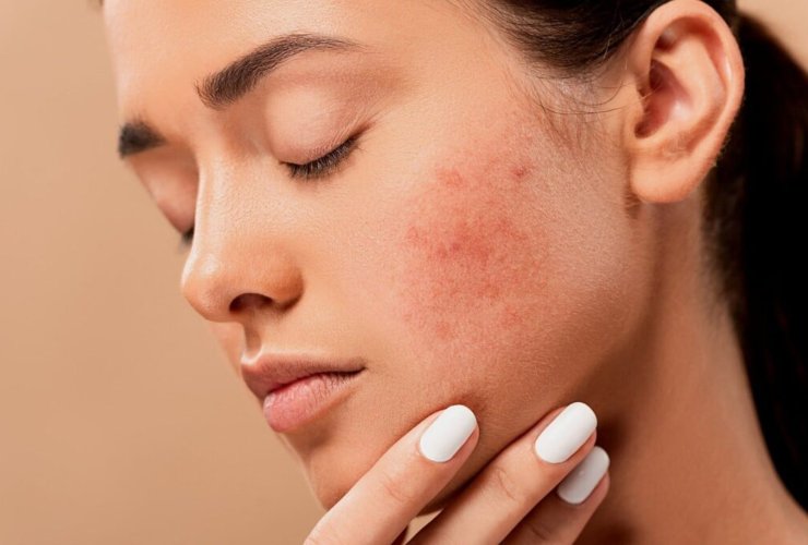 acne-eczema e psoriasi vengono curarle con l'alimentazione-Meteoweek.com