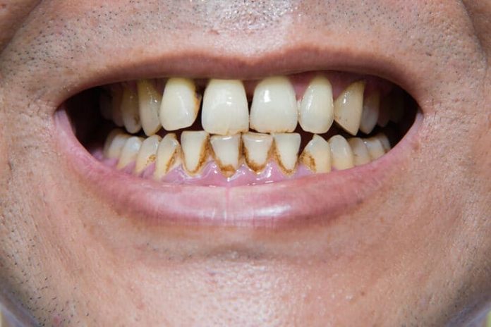 Cosa Succede Se Non Ti Lavi I Denti
