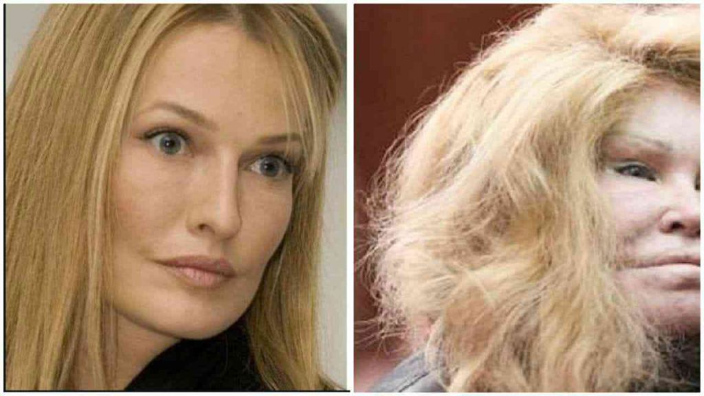 Era bellissima oggi il disastro della chirurgia estetica l’ha ridotta così [FOTO]